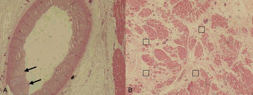 Figure 5. (A) The left anterior descending artery showed slight intimal thickening and internal elastic lamina discontinuity (black arrows) (HE×2). (B) Interstitial fibrosis (□) with capillary proliferation of left ventricle (HE×2).