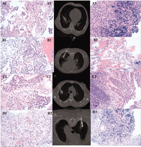 Figure 2. Pathology changes in the four groups. Group A: A1 (adenocarcinoma before MWA), A2 (MWA followed by immediate biopsy), A3 (adenocarcinoma after MWA); Group B: B1 (adenocarcinoma before MWA), B2 (MWA followed by immediate biopsy), B3 (adenocarcinoma after MWA, with burning degeneration). Group C: C1 (squamous cell carcinoma before MWA), C2 (MWA followed by immediate biopsy), C3 (definite cancer cells, no definite histology type); Group D: D1 (squamous cell carcinoma before MWA), D2 (MWA followed by immediate biopsy), D3 (no definite cancer cell).