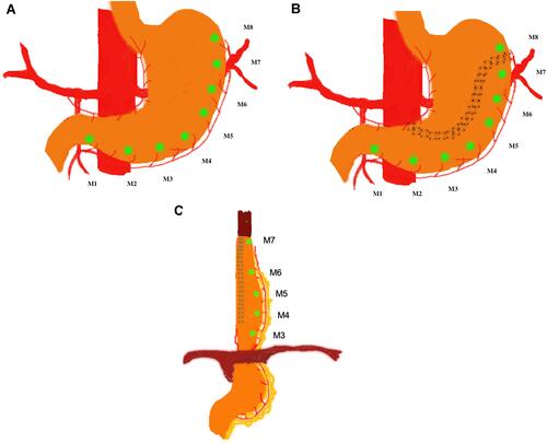 Figure 2 (A–C). Measuring points M1 to M8 (green dots) at baseline, after gastric tube construction, and gastroesophageal anastomosis.