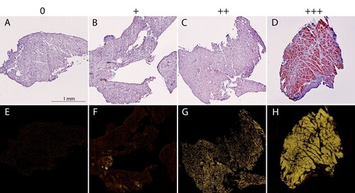 Figure 2. Grading of amyloid content in fresh frozen endomyocardial biopsy specimens after staining with Congo red. (A-D) The CR-stained sections viewed under bright field microscopy. (E-H) The CR-stained sections viewed by fluorescence microscopy and Texas red filter (yellow). The biopsy specimens show varying degree of amyloid deposition, 0 = 0%, + = <5%, ++ = 5-20%, +++ = >20%.