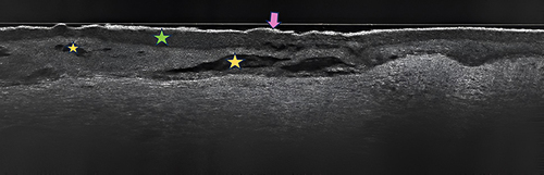 Figure 5 Vertical LC-OCT (line-field optical coherence tomography) section depicting numerous macro and micro vesicles in the epidermis (yellow stars); stratum corneum thickened (green star), stratum disjunctum continuous, undisrupted (pink arrow); stratum spinosum of different thicknesses with inhomogeneous areas.