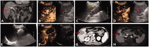Figure 4. A representative case of multiple MWA sessions for HCC abutting large vessel. (A) Preoperative MRI scan showed one nodule (red arrow) adjacent to the right anterior branch of portal vein. (B) Contrast-enhanced ultrasound showed a hyperechoic nodule with enhancement in the arterial phase. (C) Insertion of antenna (yellow arrow) to the nodule (red arrow) under the guidance of ultrasound. (D) After the first MWA session, reexamination of contrast-enhanced ultrasound showed local enhancement of the focus (red circle). (E) Second MWA session was performed, the antenna (yellow arrow) was inserted into the residue focus. (F) After the second MWA session, contrast-enhanced ultrasound showed that the nonenhancing ablation zone (yellow arrow) covered the original focus, the nodule was completely ablated. (G) On the arterial phase of postoperative CT scan, no enhancement was observed in the ablation zone. (H) On the MRI scan one and a half year after MWA, the ablation zone (red arrow) shrank with no local recurrence.