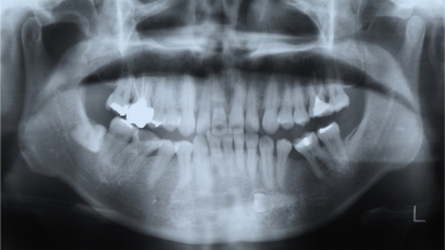 Figure 2 Right horizontal incompletely impacted third molar without lamina dura below the crown in a 39-year-old woman.