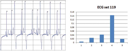 Figure 8. ECG set 119: A time/amplitude plot and the reduction in mutual information when one of the features (5) is left out.