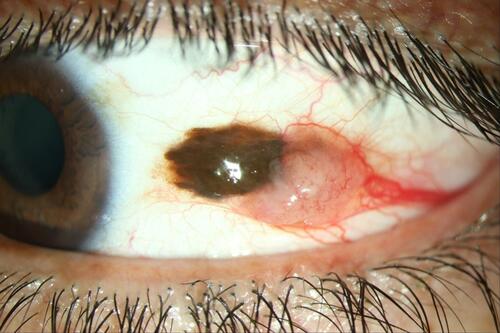 Figure 1 Melanoma of the temporal bulbar conjunctiva with a prominent feeder vessel in the left eye of a patient.