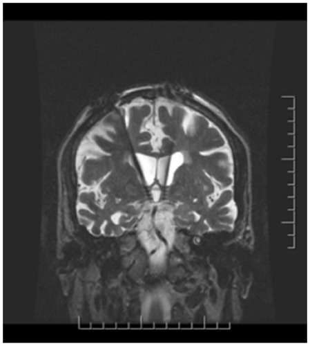 Figure 2 Coronal MRI demonstrating placement of the DBS electrodes anterior and parallel to the vertical portion of the fornix within the hypothalamus bilaterally.