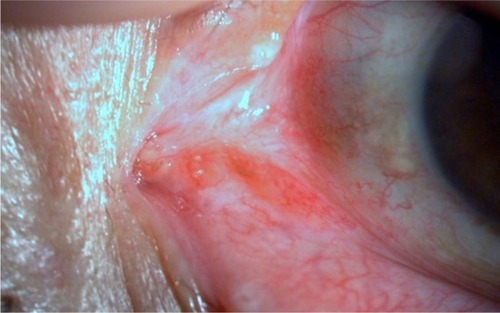 Figure 4 Clinical appearance after resection of the tumor.