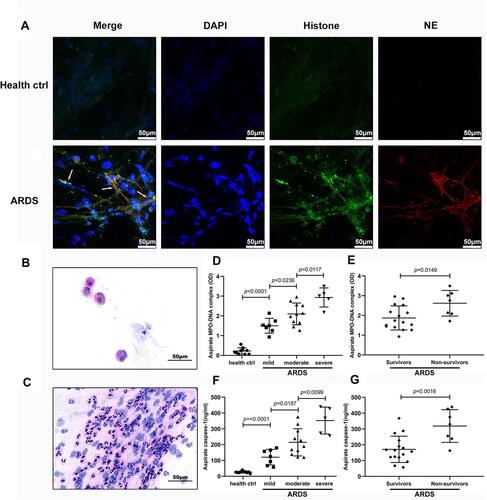 Figure 1 NET and caspase-1 levels are increased in patients with ARDS caused by gram-negative bacteria. (A) NETs were found in the bronchial aspirates of ARDS patients but not in in healthy controls. (B and C) Alveolar macrophages were found in the bronchial aspirates of healthy volunteers, whereas massive neutrophil infiltration was found in ARDS patients. (D) NET (F) and caspase-1 levels in bronchial aspirates were significantly higher in ARDS patients than in healthy controls There were also significant differences in the levels of NETs and caspase-1 between patients with mild, moderate and severe ARDS. (E) NET and (G) caspase-1 levels in bronchial aspirates were significantly higher in nonsurviving patients than in survivors.