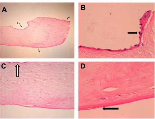 Figure 2 (A) Low power shot of the removed donor button to show full thickness of specimen at one side. Here there is epithelium (e) on part of the anterior face of the specimen. Also, Descemet’s membrane (d), is present on the back of the specimen, as well as, focally, at the front on this edge (hematoxylin and eosin, original magnification ×4). (B) Hematoxylin and eosin, original magnification ×40 to show epithelium along the anterior aspect of the specimen (arrow). Note that there is no Descemet’s membrane. (C) Hematoxylin and eosin, original magnification ×10 of the removed donor button shows view of area beneath epithelium. Arrow shows epithelium on the anterior face of the specimen. Posteriorly there is no endothelium. (D) High power of the back of the removed donor button specimen (hematoxylin and eosin, original magnification ×40). Shows graft Descemet membrane with some thickening and incipient guttae (arrow). There is no endothelium, suggestive of graft failure. Note the normal relationship of Descemet membrane to stroma.