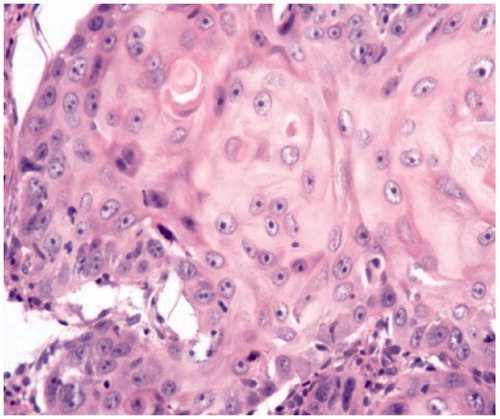 Figure 2. H&E-stained (20×) photomicrograph showing keratinization, intercellular bridge, and mild pleomorphism consistent with well-differentiated squamous cell carcinoma.