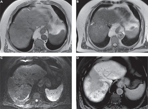 Figure 4 Anaplastic hepatocellular carcinoma (HCC) following radioembolization. Plain T1-weighted spoiled 2D gradient echo (GRE) A) T2-weighted half-Fourier acquisition single-shot turbo spin-echo (HASTE) B) diffusion-weighted imaging (DWI) C) and hepatocellular phase gadoxetic acid-enhanced fat-suppressed (FS) T1-weighted spoiled 3D GRE D) in the axial plane. The large hypointense zone in segment 8 resembles an area following radioembolization of the previously more circumscribed tumor. Multiple new satellite tumors can only be appreciated on gadoxetic acid-enhanced MRI.