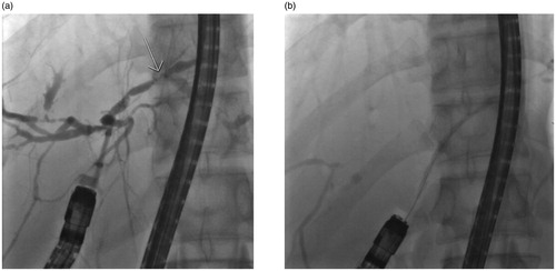Figure 9. The fluoroscopy views of patient (number 6) with left site intrahepatic stricture (a) before and (b) after stenting with Archimedes stent.