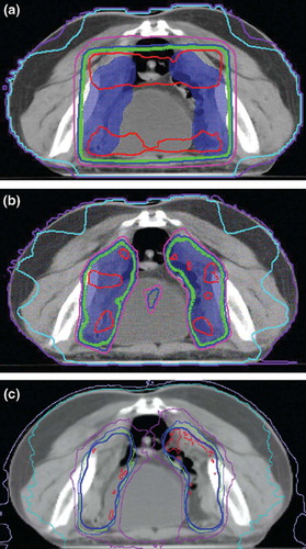 Figure 1. Typical axial dose distributions obtained with three-dimensional conformal radiotherapy, intensity-modulated radiotherapy, and helical tomotherapy. The shown isodose lines included 53.5 Gy, 50.0 Gy, 47.5 Gy, 45.0 Gy, 20.0 Gy and 10.0 Gy. The PTV was shown in blue.