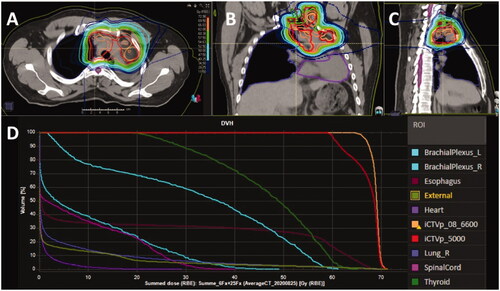 Figure 2. The summed dose distribution of the proton beam treatment plans R1, R2A and R2B covering the high-dose clinical target volume (CTV; iCTVp_08_6600) and the elective CTV (iCTVp_5000) is shown in transverse (A), coronal (B) and sagittal (C) views. The 62 Gy(RBE) isodose line is depicted in orange. The dose-volume histogram for the summed dose is presented in (D).