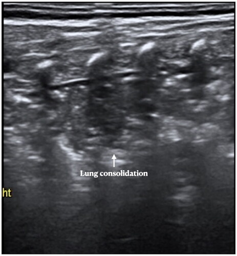 Figure 10. LUS manifestations in pneumonia. Patient with pneumonia. LUS showed large area lung consolidation with air – air-bronchograms, as well as irregular and serrated boundaries. We can see the consolidation is much different from that in RDS patients. The ultrasound findings of MAS were similar to those of pneumonia. Their identification needs to be combined with medical history, such as the time of onset, the presence of meconium contamination of amniotic fluid, etc.