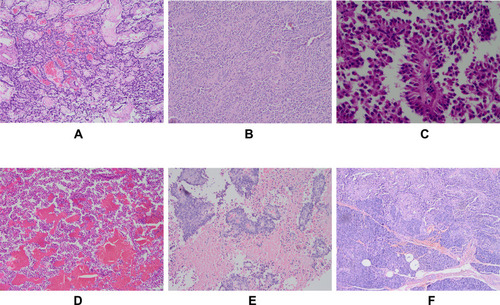 Figure 1 Histopathological characteristics of solid-pseudopapillary neoplasm (SPN) based on hematoxylin and eosin (H&E) staining. (A) The tumor cells have various shapes, forming clusters of different sizes with hemorrhage, cystic, and pseudopapillary structures (magnification, ×100). (B) The tumor is mainly a solid area, with less interstitial components (magnification, ×200). (C) The tumor cell cytoplasm is eosinophilic or lightly stained, the nucleus is oval, the chromatin is fine, and mitotic images are rare (magnification, ×400). (D) The tumor has a wide hemorrhagic area with cystic degeneration (magnification, ×200). (E) The cells distant from the blood vessels degenerate and fall off, and the tumor cells around the blood vessels surround the blood vessels to form pseudopapillary structures (magnification, ×200). (F) The tumor infiltrates surrounding normal pancreatic tissue (magnification, ×100).
