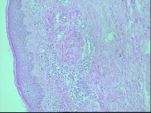 Figure 5 Case 3: skin biopsy before treatment shows eosinophils in the superficial layer of dermis, inflammatory cells in vessel walls, and fibrinoid necrosis in a few vessel walls.