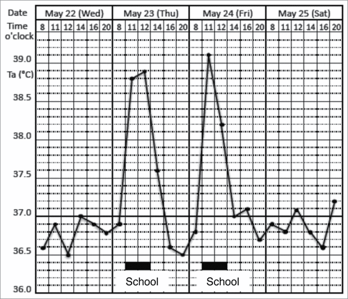 Figure 1. Prominent psychogenic fever observed in a 15-year-old schoolgirl. She was referred from a pediatrician to my outpatient clinic because she repeatedly developed antipyretic drug-resistant fever of unknown causes. I asked the patient to record her axillary temperature (Ta) using an electrothermometer 4 times a day (8 a.m., 12 a.m., 4 p.m., and 8 p.m.) and the events of the day in a “fever diary” to better understand mind (stressor)-body (temperature) relationships. I also asked her mother and school nurse to make sure the temperature she recorded was accurate. The fever diary demonstrated that she developed a high Ta up to 39°C only on the days when she went to school (underlined black bar). (Unpublished observation.)