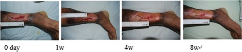 Figure 7. Lv Bokun, male, 56 years old, suffered from skin ulceration of the right lower extremity with infection. The infection remained recurrent and uncured for more than 2 months. The wound healing rate was 83% after 8 weeks of routine dressing change treatment.