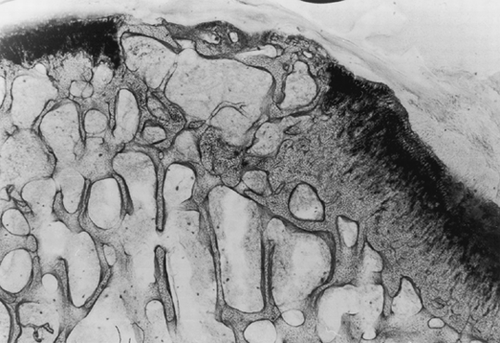 Figure 3. Osteochondral defect at 24 weeks without laser treatment (toluidine blue). Magnification: ×2.5. The repaired tissue appears disorganized and reveals an irregular growth of the reconstituted bony tissue, a thin layer of fibrous tissue on the articular surface and the absence of chondrocytes.