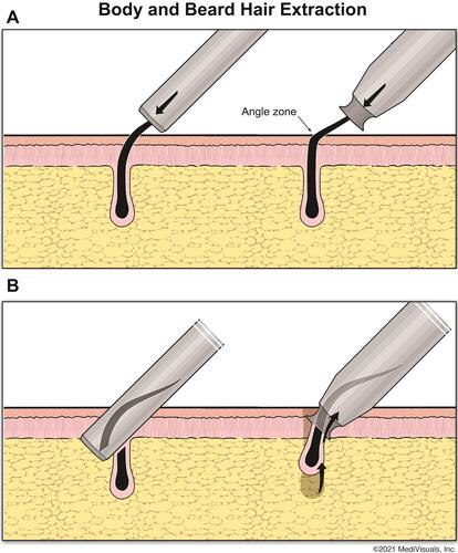 Figure 7 The angular point of the graft in the crosshairs of the cutting edge of advancing punches. (A) A conventional punch transects the angulated hair follicle at its maximum inflection point; (B) The textured all-purpose punch pulls the follicle, keeping the angulated portion inside the punch lumen before contacting the cutting tip of the punch.