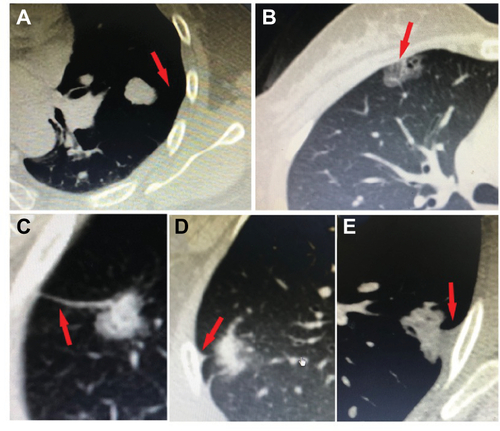 Figure S1 Five types of tumor–pleural surface relationship.Notes: (A) No contacting, (B) abutting pleural, (C) pleural tag type I, (D) pleural tag type II, and (E) pleural tag type III. The red arrows illustrate the five types of tumor–pleural surface relationship on CT images.