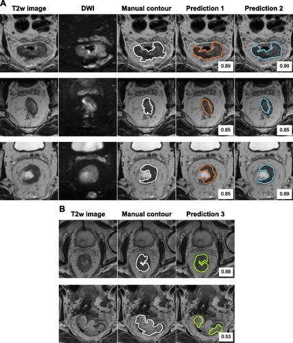 Figure 4. Illustration of predicted contours made by the best models and corresponding DSC value. (A) For three patients in C1, the T2-weighted (T2w) image and the diffusion weighted imaging (DWI) (b = 500s/mm​2) are shown. Manual delineations by radiologist R1 are shown as contour. Predictions made by the best T2w image-based model (Prediction 1) and the best model using T2w + DWI (Prediction 2) are shown (cf. Figure 2). (B) For two patients in C2, the T2w image and manual delineation are shown. The predicted segmentation (Prediction 3) was made using the best T2w-based model trained on C1.