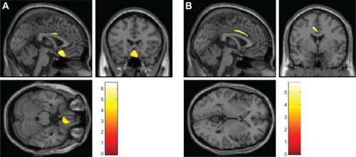 Figure 1 (A) Smaller regional GM volumes were observed for the right orbitofrontal cortex and left cingulate cortex in nonresponder OCD patients (n=15), compared with responder OCD patients (n=24). (B) Smaller regional WM volumes were observed for the left cingulate bundle in nonresponder OCD patients (n=15), compared with responder OCD patients (n=24).
