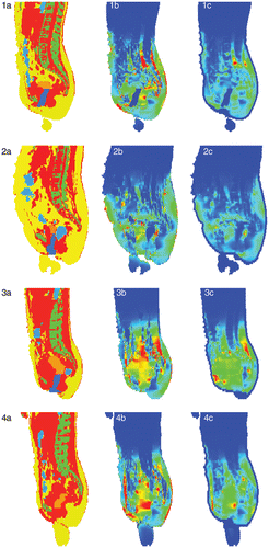 Figure 3. Sagittal cross sections of the segmented anatomy (red: muscle; yellow: fat; orange: tumour; green: bone; blue: (inner) air, water or saline) for the four cases (panels 1a–4a). The calculated SAR distributions (SARcalc) are shown in panels 1b–4b, ranging from 0 W kg−1 (blue) to 50 W kg−1 (red), from 0 to 50 W kg−1, from 0 to 75 W kg−1, and from 0 to 60 W kg−1, respectively. The corresponding calculated temperature rise distributions after 30 s are shown in panels 1c–4c, ranging from 0°C (blue) to 0.75°C (red) for all panels. Note the superficial low temperature rises (∼0°C) due to bolus cooling.