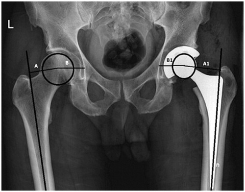 Figure 1. The global FO was measured by addition of the distance between the longitudinal axis of the femur and the center of the femoral head (A1) and the distance from the center of the femoral head to a perpendicular line passing through the medial edge of the ipsilateral teardrop point of the pelvis (B1). The measurement was repeated bilaterally to compare the global FO of the operated side (A1 + B1) to that of the unoperated hip (A + B).