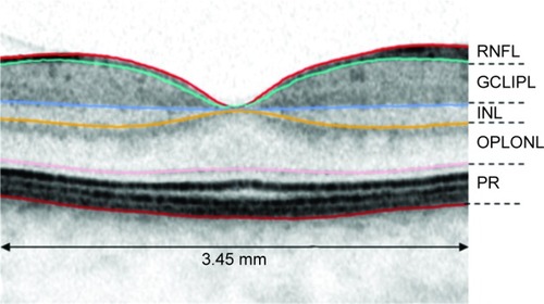 Figure 1 Schematic illustration of 3.45 mm diameter grid and chosen retinal layers for segmentation.Abbreviatons: RNFL, retinal nerve fiber layer; GCLIPL, ganglion cell/inner plexiform layer; INL, inner nuclear layer; OPLONL, outer plexiform layer/outer nuclear layer; PR, photoreceptor complex.