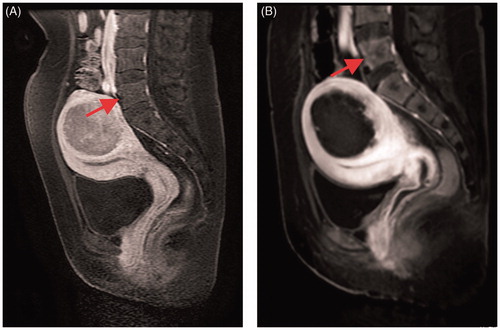 Figure 2. CE-MRI before and after USgHIFU ablation: (A) the fifth lumbar spine shows normal before treatment; (B) the front edge of the fifth lumbar spine shows non-perfused upon CE-MRI immediately after treatment.