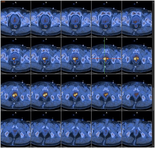Figure 3. PET/CT: prostate protruding into the bladder was enlarged, with abnormal increases in glucose metabolism of the local lesion, considered to be a malignant tumor, and hypermetabolic pelvic lymph nodes, which should be considered for metastasis.