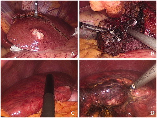 Figure 2. Photomicrographs representing main steps of microwave ablation-assisted laparoscopic hepatectomy. (A) Representative photo from a 57-year-old female patient who presented with mild liver cirrhosis and enough hepatic functional reserve demonstrating a pre-excision line spaced 2 cm from the tumor margin. Medical gauze was used to protect adjacent viscera from possible heat injury. (B) Representative photo from the same 57-year-old female patient representing the clipping of branches of the Glisson pedicles encountered in the process of liver resection using Hem-o-lock clips to ensure stump hemostasis and biliostasis. (C) Representative photo from a 42-year-old female patient who presented with severe liver cirrhosis and poor liver functional reserve. Laparoscopic ultrasound scanning was undertaken to determine the tumor margin and the transection line before parenchymal-sparing hepatectomy. (D) Representative photo from the same 42-year-old female patient who presented with severe liver cirrhosis. Precoagulation was performed closer to the tumor margin to preserve the liver parenchyma.