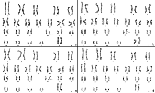 Figure 1 The chromosome karyotype of the patient. (a) 46, XX, del(16)(q22), black arrow points the deletion at 16q22; (b) 46, XX, fra(16)(q22), black arrow points the fragile site at 16q22; (c) 46, XX, fra(16)tr(16)(q22), black arrow points the duplication at 16q22; (d) 46, XX.