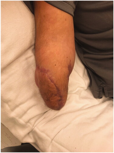 Figure 7. Follow up at post-op week 10 showing excellent wound healing and coverage of the stump defect, dorsoradial aspect.