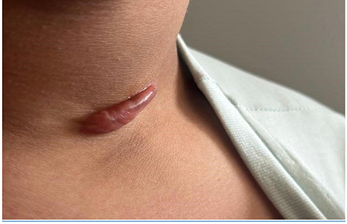 Figure 2 Keloid scar two weeks post-treatment with three sessions of intralesional steroid injections combined with two sessions of cryotherapy.