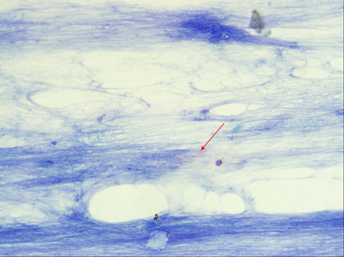 Figure 3 Smear of the perianal ulcer secretion showing tuberculosis bacilli.(The red arrow indicates the presence of tuberculosis bacilli.).