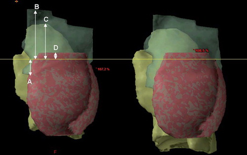Figure 2. CTV (translucent green), mammary tissue (pink) and ipsilateral lung (yellow) for the same patient during FB (left) and DIBH (right). The yellow line shows the craniocaudal position of the isocenter. The white arrows show the measured distances from isocenter to the caudal limit of the internal mammary nodes (A), from isocenter to the cranial limit of CTV (B), from isocenter to cranial limit of the ipsilateral lung (C), as well as the distance from isocenter to the cranial limit of the mammary tissue (D). CTV, clinical target volume; DIBH, deep inspiration breath-hold; FB, free breathing.
