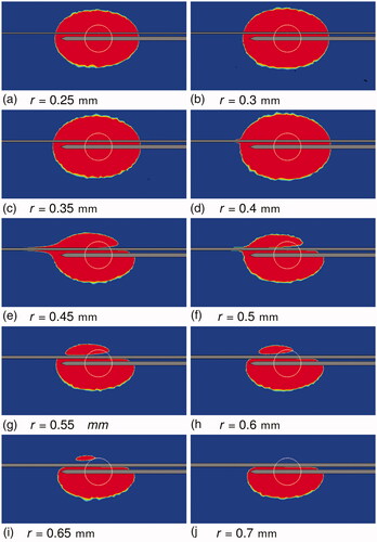 Figure 8. Thermal lesion at the end of the simulation for 0.25 mm ≤r≤ 0.7 mm. The tissue section containing the vessel axis and the RF-needle axis is shown. The top horizontal band in each image is the blood vessel section. Blood flow was from right to left. The bottom horizontal ‘half-band’ is the RF-needle. Blue indicates healthy tissue and red indicates ablated tissue. The white circle is the tumor boundary.