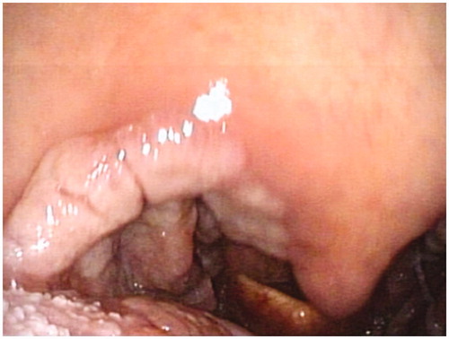 Figure 1. Endoscopic image of the right tonsillar lesion showing an ulcerated tumor.