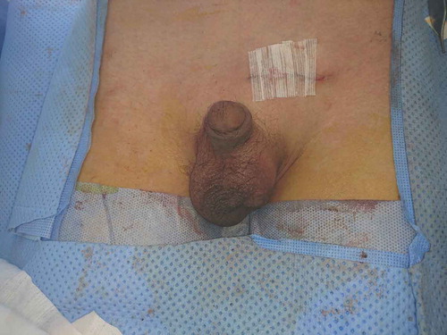 Figure 4. Testis fixed in the scrotum and wound closed.