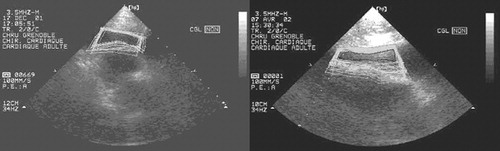 Figure 7. Evaluation of the stable zone in apnea.