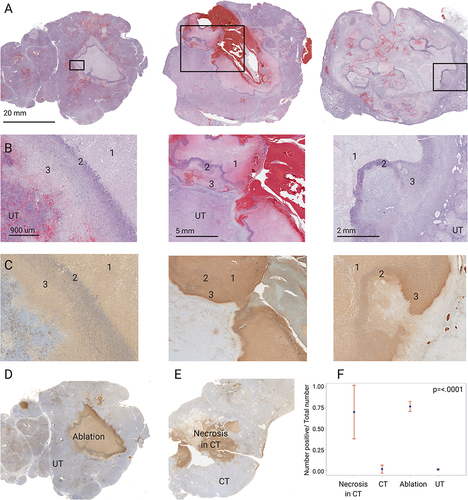 Figure 2 Cryolesion architecture on H&E and TUNEL stains. (A) Representative H&E-stained sections of the 3 cryolesions. In the left panel a defined cryolesion with central coagulative necrosis surrounded with a homogenous rim is demonstrated. The middle panel demonstrates a cryolesion with apparent hemorrhage along the needle track and less homogeneous cryolesion rims (reprinted from.Citation19 with permission). The right panel shows the ablation zone with liquefactive necrosis surrounded by a rim of cell debris that can be found in the central ablation zone as well as in the periphery. Magnified (B) H&E-stained and (C) TUNEL stained sections of the regions marked in (A) delineating the 3 compartments within the cryolesion: central necrosis (1), cell debris rim (2) and coagulative necrosis outer rim (3). Tumor tissue that was not cryoablated is marked with UT (untreated tumor). TUNEL stain annotation was performed on 4 regions. Two regions in the ablated tumor, the ablation zone and untreated tumor (UT), are shown on panel (D). Spontaneous necrosis and control tumor (CT) in untreated animals were evaluated as well both regions represented in panel (E). (F) TUNEL stain quantification, control animals N=7, cryoablated animals N=3, 1–2 sections per animal, p-value for the entire test is shown on the graph. P-values between pairs of regions are summarized in Table 1.