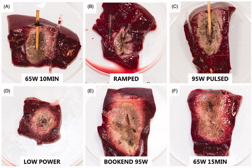 Figure 3. Representative images of the ablation zones after TTC staining illustrate differences between the various protocols. The photographs are to scale. (A) 65 W continuous for 10 min (65W 10MIN), (B) 25 W–65W ramped protocol (RAMPED), (C) high-power pulses with 31–32 s cooling pauses (95W PULSED), (D) low-power 40 W continuous for 16 min 15 s (LOW POWER), (E) 95 W pulse for 1 min, followed by continuous 65 W for 8 min, then a second 1 min 95 W pulse with no interleaved cooling pauses (BOOKEND 95W), (F) 65 W continuous for 15 min (65W 15MIN).