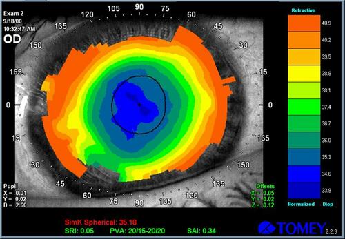 Figure 1 Videokeratographic map of the right eye of a 32 yrs old male patient treated with PRK with the MEL-70 excimer laser (Carl Zeiss Meditec). Preoperative refraction was −4.50sph with a DCVA of 20/20. Eight months after PRK, his DCVA was 20/20 with −0.25sph. The treatment was well centered and effective.