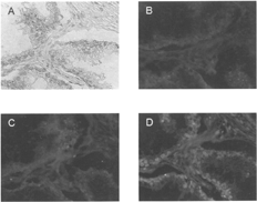 6 Localization of ODN-DV complexes in paraffin-embedded tissue sections of human prostate carcinoma (×100). Tissue sections were processed as described in the Materials and Methods section of this article. Light microscopy: (A); Fluorescence: (B) ODN alone, (C) ODN-DVIgG, and (D) ODN-DVPSA.