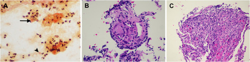 Figure 2 (A–C) Mucicarmine staining of BAL fluid cytology ((A), x400) show intracellular yeasts, engulfed by macrophages (arrow in (A)), and extracellular yeasts with thick capsule (arrowhead in (A). Histopathologic sections of the left lower lobe and right upper lobe biopsies reveal non-necrotizing granulomatous inflammation ((B), H&E stain, 400x) and organizing pneumonia ((C), H&E stain, 400x), respectively.