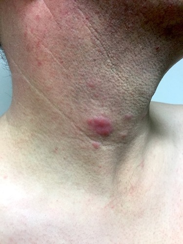 Figure 1 Clinical picture of Lupus erythematosus tumidus: erythematous, urticarial plaque and papules on the neck of a 43-year old male smoker. Consent was received for the publication of this image.