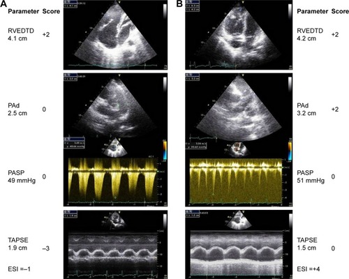 Figure 3 Representative echocardiographic images of RVEDTD, PASP, PAd, and tricuspid annular plane systolic excursion as well as the score calculation for two patients. Column A (top to bottom) shows ↑RVEDTD and ↑PASP (score =−1). Invasive hemodynamics: mPAP =30 mmHg, PAWP =11 mmHg, PVR =6.0 Wood units, and cardiac index =3.1 L/min/m2. Column B shows ↑RVEDTD, ↑PASP, ↑PAd, and ↓TAPSE (score =4). Invasive hemodynamics: mPAP =39 mmHg, PAWP =11 mmHg, PVR =6.0 Wood units, and cardiac index =3.35 L/min/m2.
